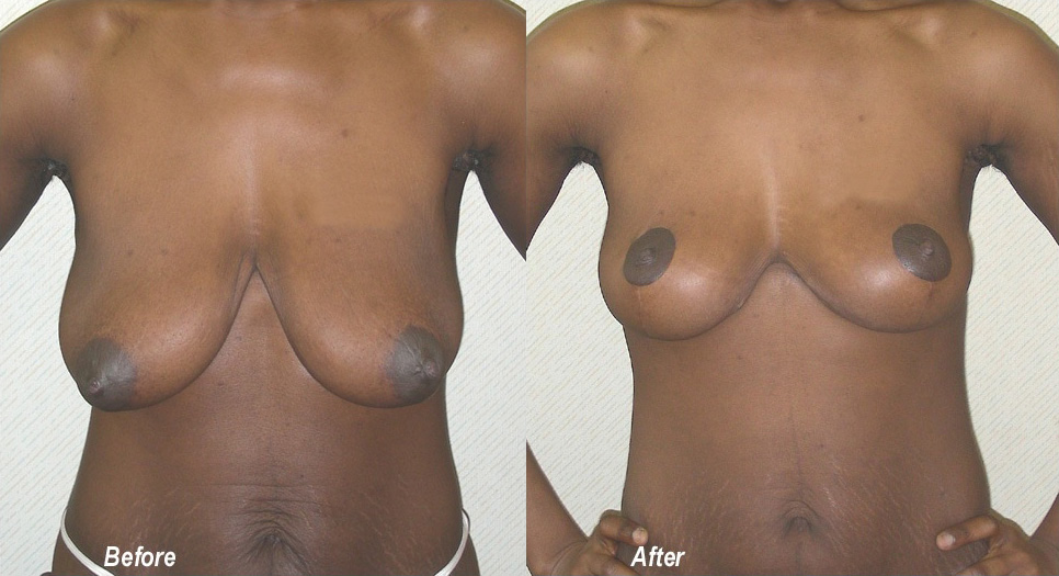 Breast Lift Before and After Photo by Ganchi Plastic Surgery in Northern New Jersey