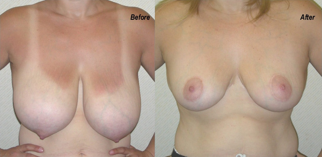 Breast Lift Before and After Photo by Ganchi Plastic Surgery in Northern New Jersey