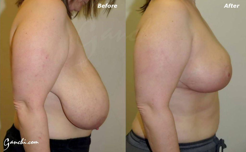 Breast Reduction Before and After Photo by Ganchi Plastic Surgery in Northern New Jersey