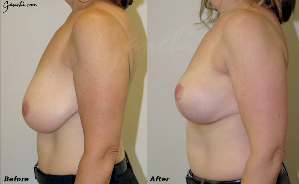 Breast Reduction Before and After Photo by Ganchi Plastic Surgery in Northern New Jersey