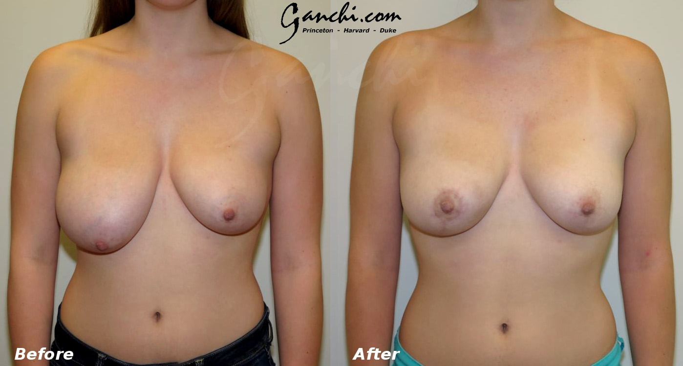 Breast Reduction Before and After Photo by Ganchi Plastic Surgery in Northern New Jersey