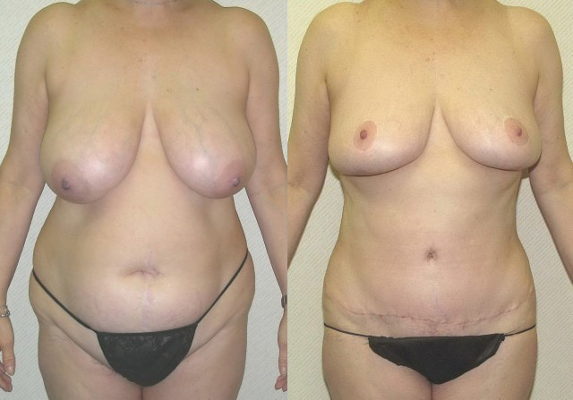 Breast Reduction Before and After Photo by Ganchi Plastic Surgery in Northern New Jersey