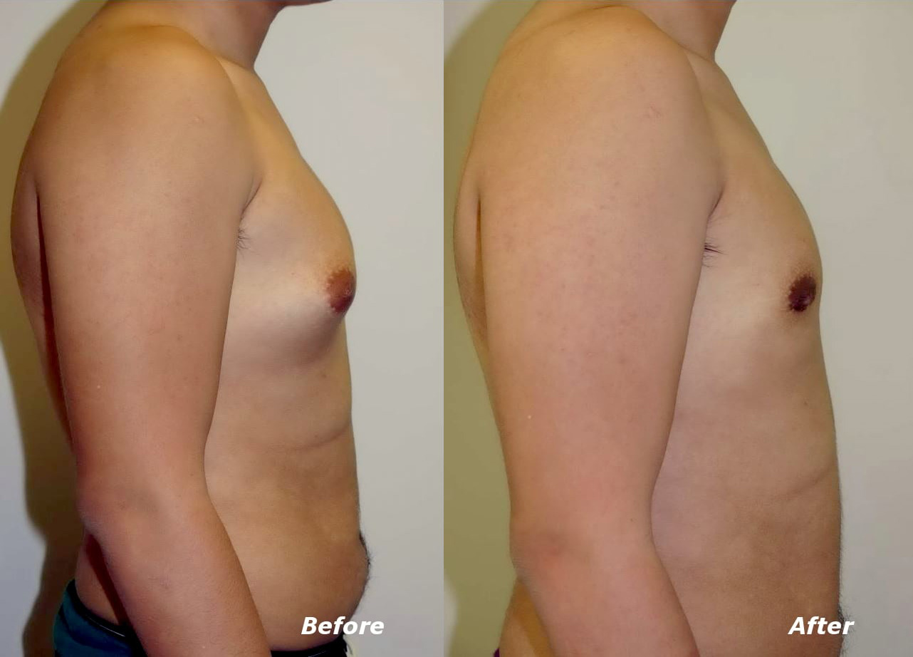 Gynecomastia Correction Before and After Photo by Ganchi Plastic Surgery in Northern New Jersey