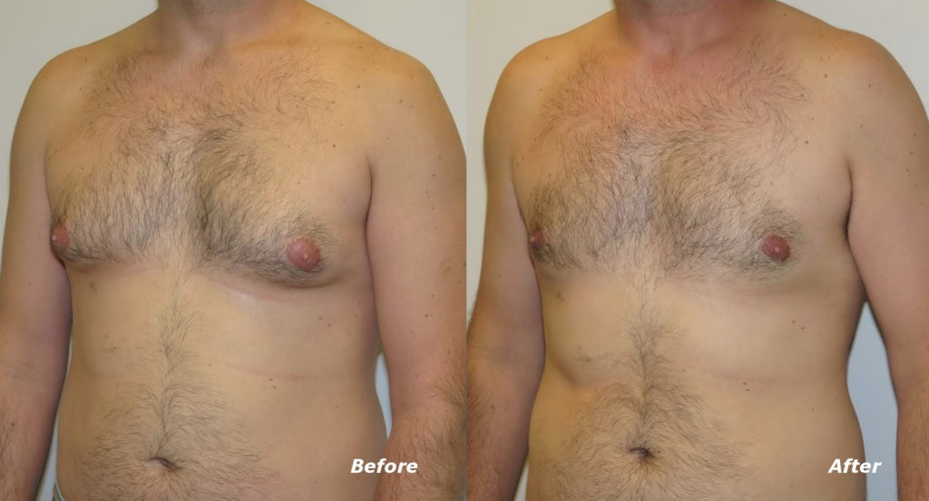 Gynecomastia Correction Before and After Photo by Ganchi Plastic Surgery in Northern New Jersey