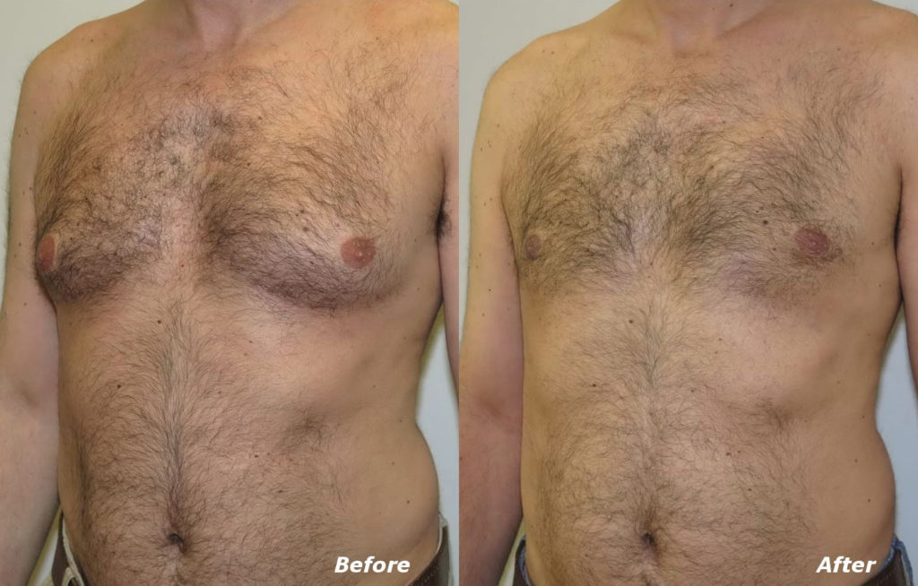 Gynecomastia Correction Before and After Photo by Ganchi Plastic Surgery in Northern New Jersey