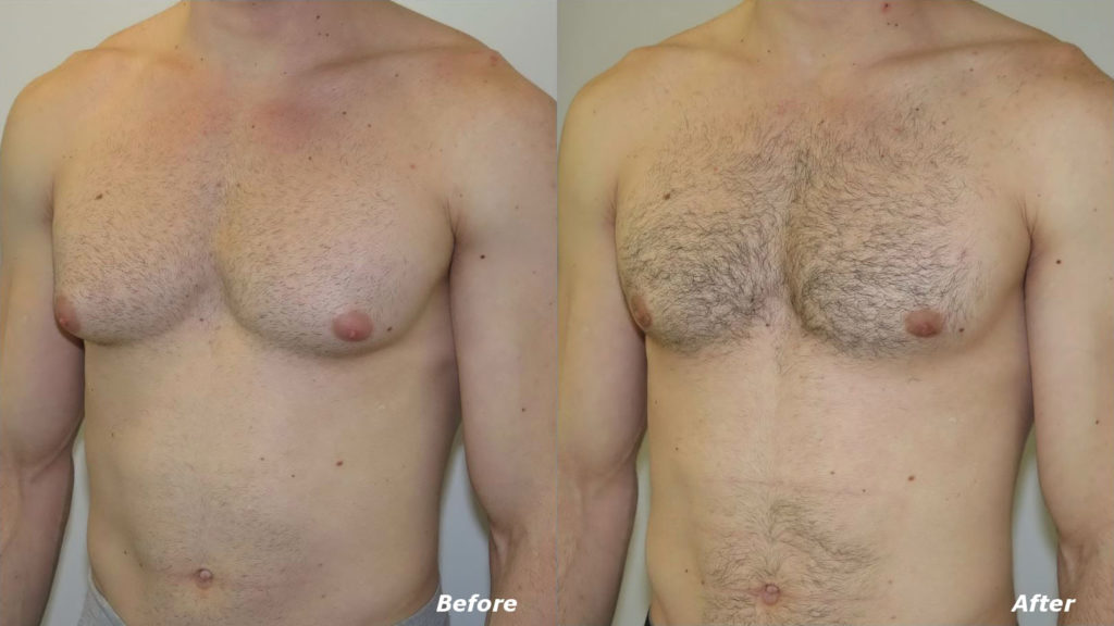 Gynecomastia Correction Before and After Photo by Ganchi Plastic Surgery in Northern New Jersey