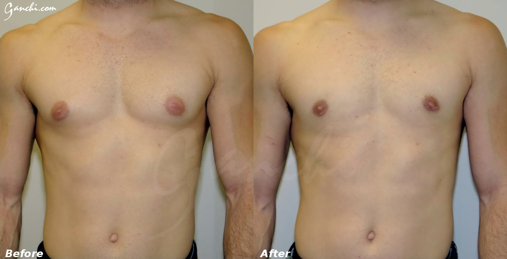 Gynecomastia Correction Before and After Photo by Ganchi Plastic Surgery in Northern New Jersey