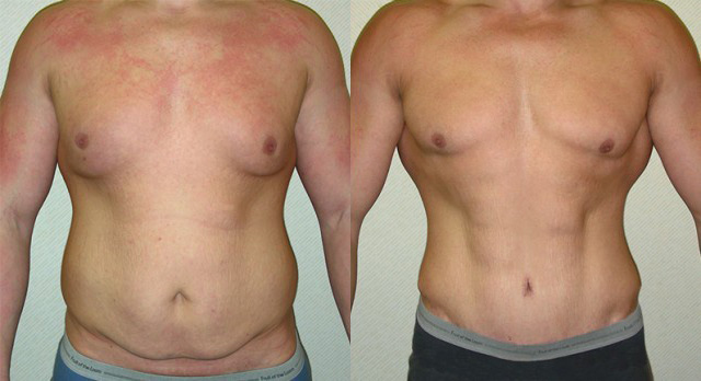 Gynecomastia Correction Before and After Photo by Ganchi Plastic Surgery in Northern New Jersey