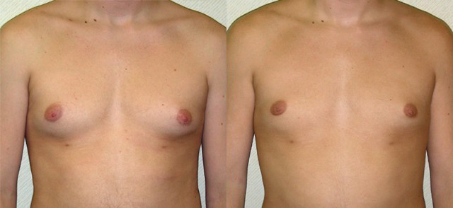 Gynecomastia Correction Before and After Photo by Ganchi Plastic Surgery in Northern New Jersey