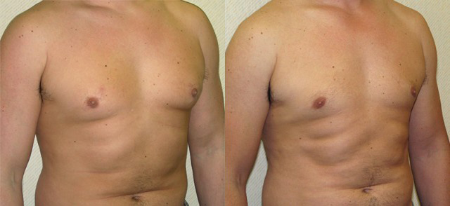 Gynecomastia Correction Before and After Photo by Ganchi Plastic Surgery in Northern New Jersey