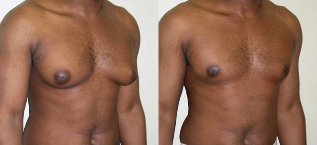 Gynecomastia Correction Before and After Photo by Ganchi Plastic Surgery in Northern New Jersey