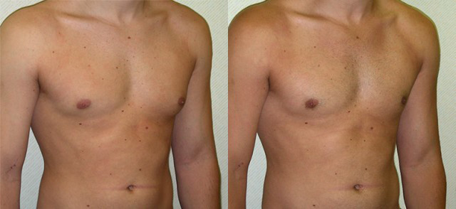 Gynecomastia Correction Before and After Photo by Ganchi Plastic Surgery in Northern New Jersey