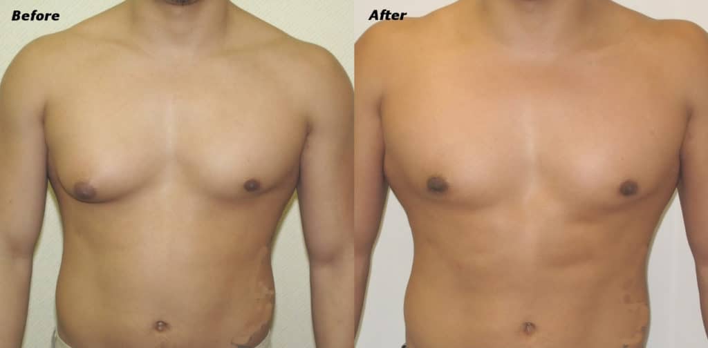 Gynecomastia Correction Before and After Photo by Ganchi Plastic Surgery in Northern New Jersey