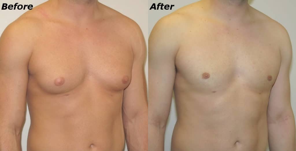 Gynecomastia Correction Before and After Photo by Ganchi Plastic Surgery in Northern New Jersey