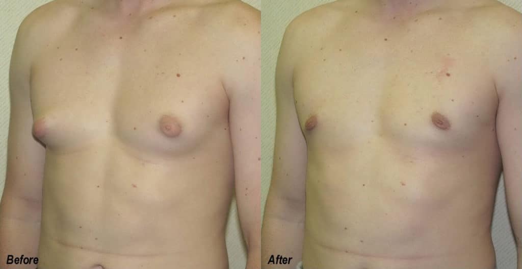 Gynecomastia Correction Before and After Photo by Ganchi Plastic Surgery in Northern New Jersey