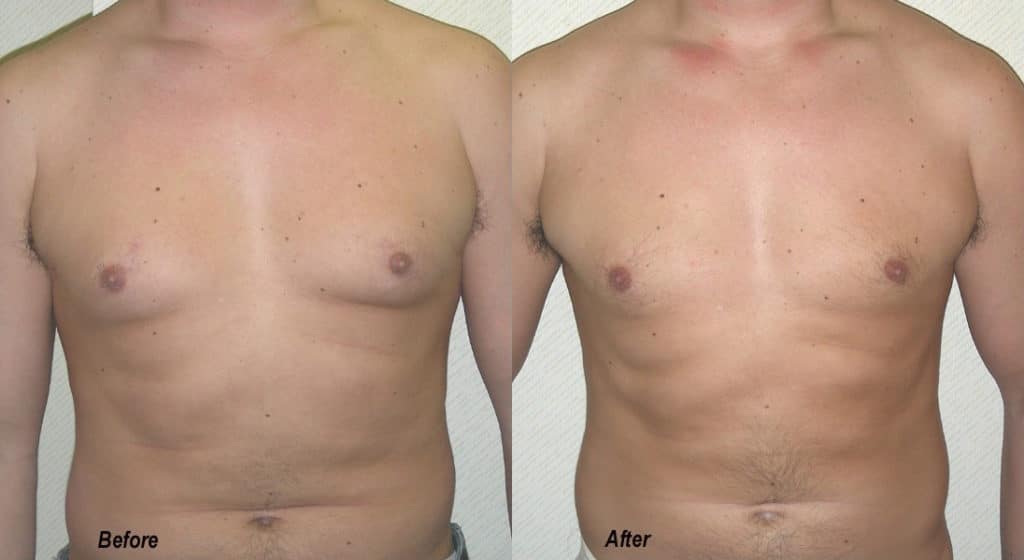 Gynecomastia Correction Before and After Photo by Ganchi Plastic Surgery in Northern New Jersey