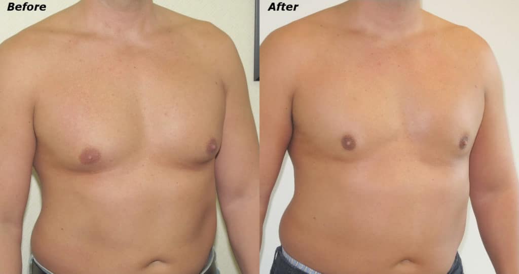 Gynecomastia Correction Before and After Photo by Ganchi Plastic Surgery in Northern New Jersey
