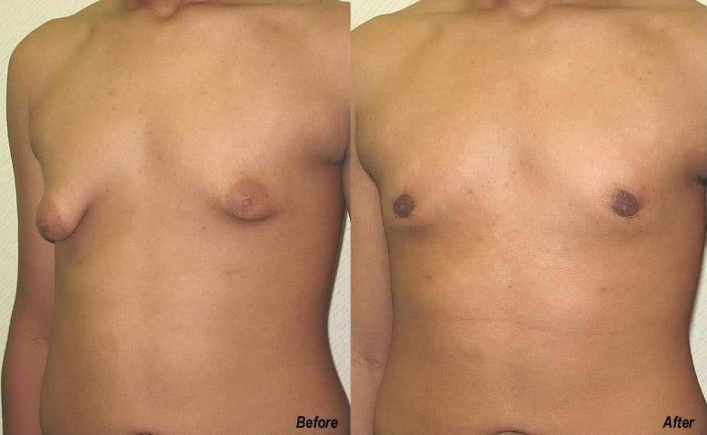 Gynecomastia Correction Before and After Photo by Ganchi Plastic Surgery in Northern New Jersey