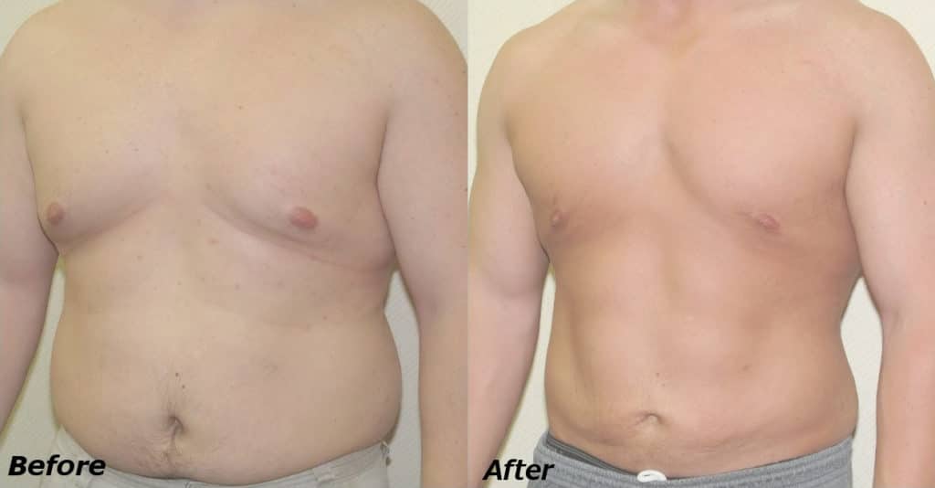 Gynecomastia Correction Before and After Photo by Ganchi Plastic Surgery in Northern New Jersey