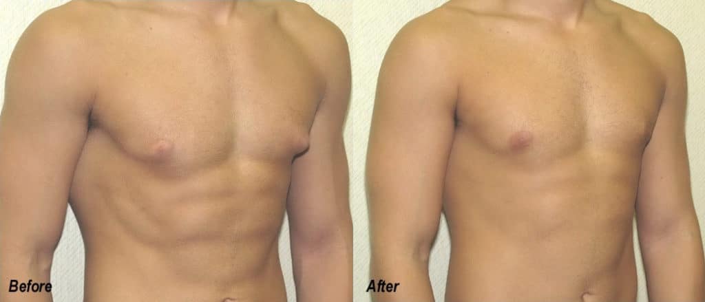 Gynecomastia Correction Before and After Photo by Ganchi Plastic Surgery in Northern New Jersey