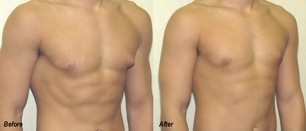 Gynecomastia Surgery Before and After Photo by Ganchi Plastic Surgery in Northern New Jersey