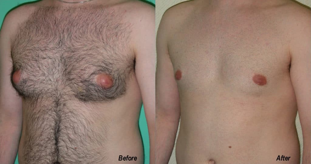 Gynecomastia Correction Before and After Photo by Ganchi Plastic Surgery in Northern New Jersey