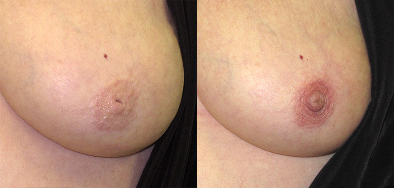 Nipple Surgery Before and After Photo by Ganchi Plastic Surgery in Northern New Jersey