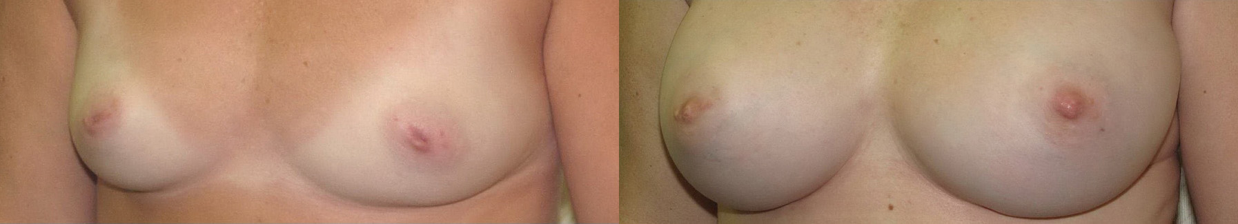 Nipple Surgery Before and After Photo by Ganchi Plastic Surgery in Northern New Jersey