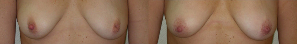 Nipple Surgery Before and After Photo by Ganchi Plastic Surgery in Northern New Jersey