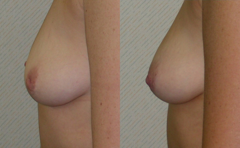 Nipple Surgery Before and After Photo by Ganchi Plastic Surgery in Northern New Jersey