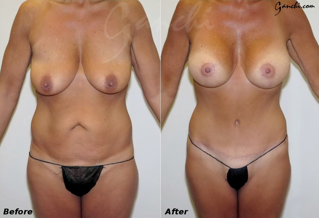 Tummy Tuck (Abdominoplasty) Before and After Photo by Ganchi Plastic Surgery in Northern New Jersey