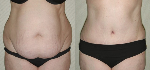 Tummy Tuck (Abdominoplasty) Before and After Photo by Ganchi Plastic Surgery in Northern New Jersey