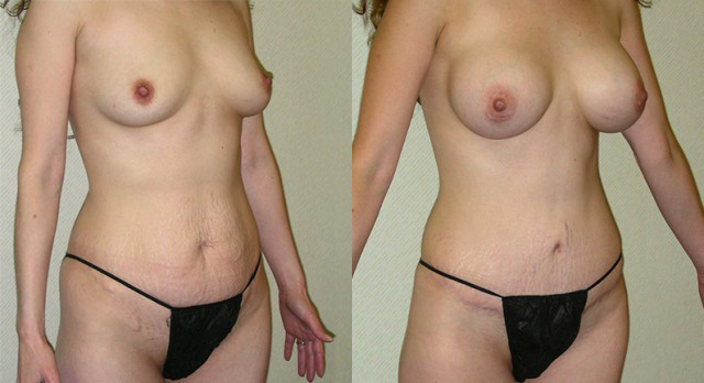 Tummy Tuck (Abdominoplasty) Before and After Photo by Ganchi Plastic Surgery in Northern New Jersey