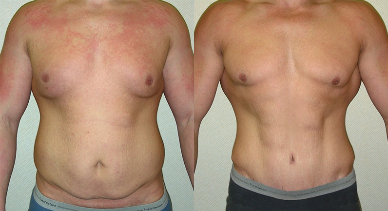 Tummy Tuck (Abdominoplasty) Before and After Photo by Ganchi Plastic Surgery in Northern New Jersey