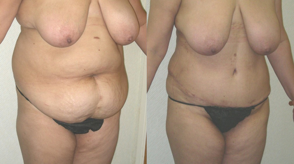 Tummy Tuck (Abdominoplasty) Before and After Photo by Ganchi Plastic Surgery in Northern New Jersey
