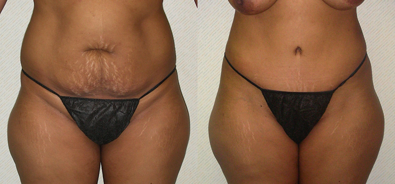 Tummy Tuck (Abdominoplasty) Before and After Photo by Ganchi Plastic Surgery in Northern New Jersey