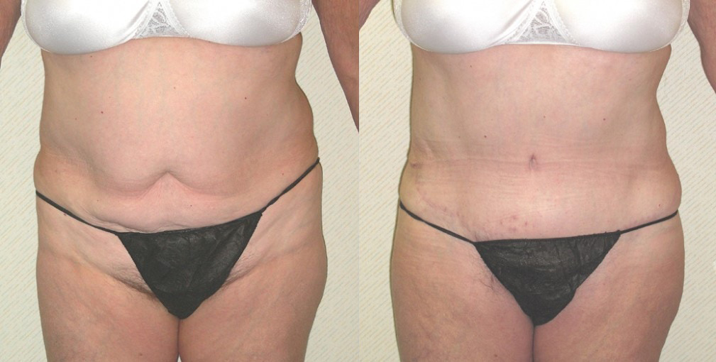 Tummy Tuck (Abdominoplasty) Before and After Photo by Ganchi Plastic Surgery in Northern New Jersey