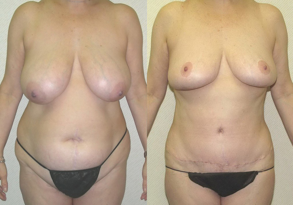 Tummy Tuck (Abdominoplasty) Before and After Photo by Ganchi Plastic Surgery in Northern New Jersey