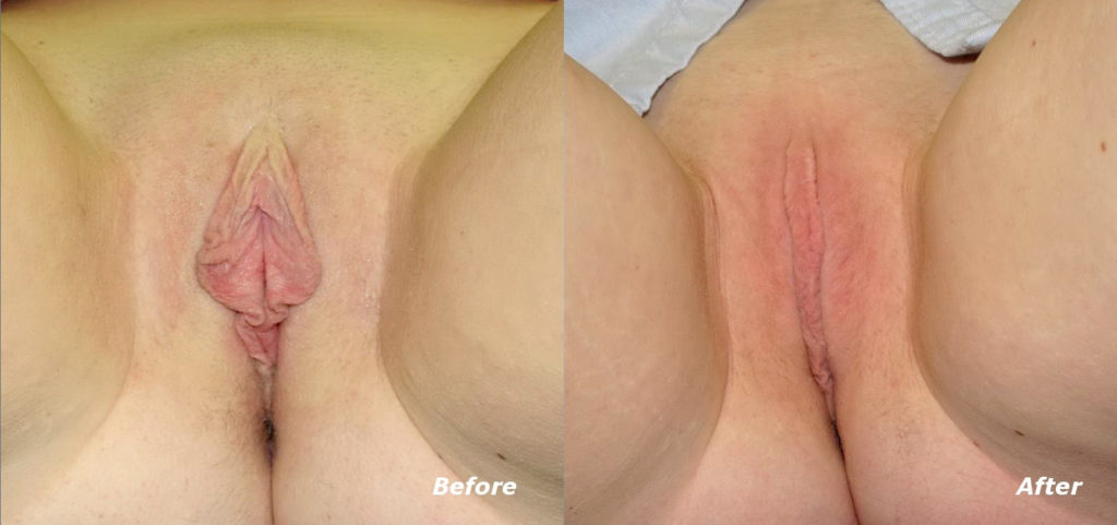 Labiaplasty Before and After Photo by Ganchi Plastic Surgery in Northern New Jersey