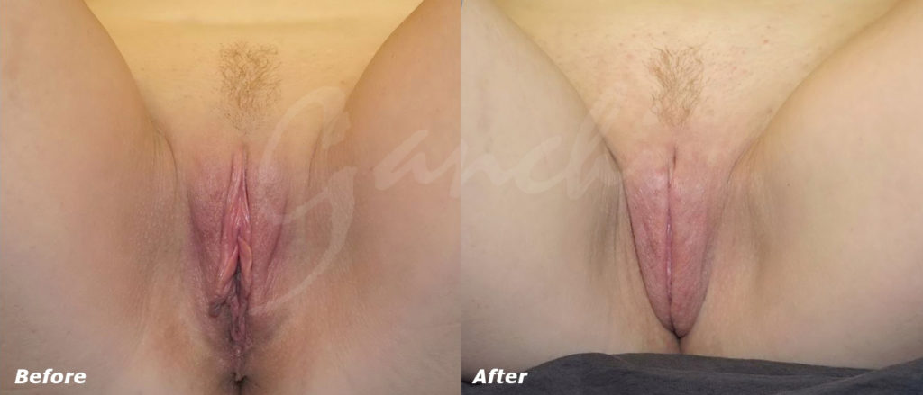 Labiaplasty Before and After Photo by Ganchi Plastic Surgery in Northern New Jersey