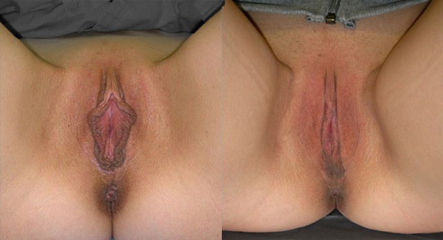 Labiaplasty Before and After Photo by Ganchi Plastic Surgery in Northern New Jersey