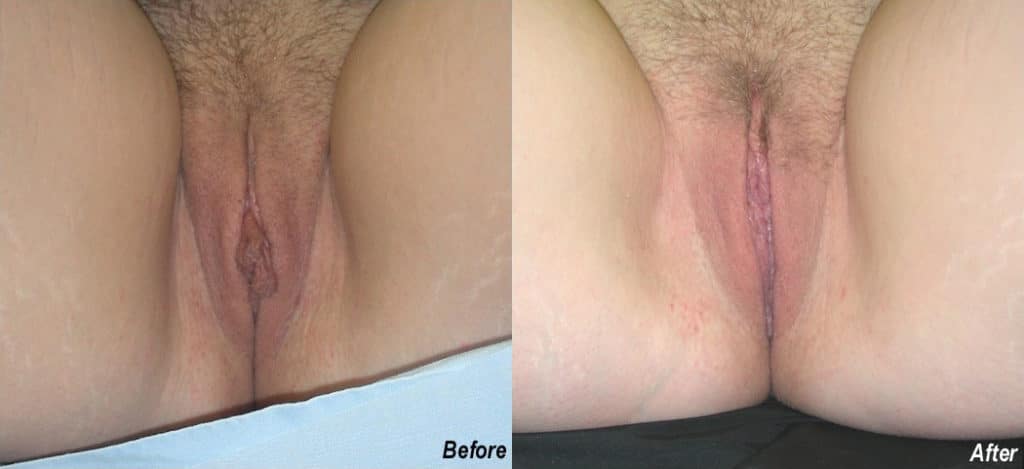 Labiaplasty Before and After Photo by Ganchi Plastic Surgery in Northern New Jersey