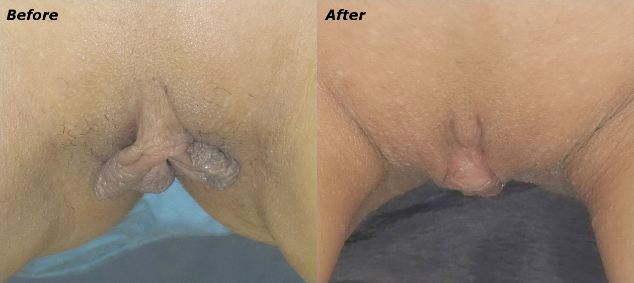 Labiaplasty Before and After Photo by Ganchi Plastic Surgery in Northern New Jersey