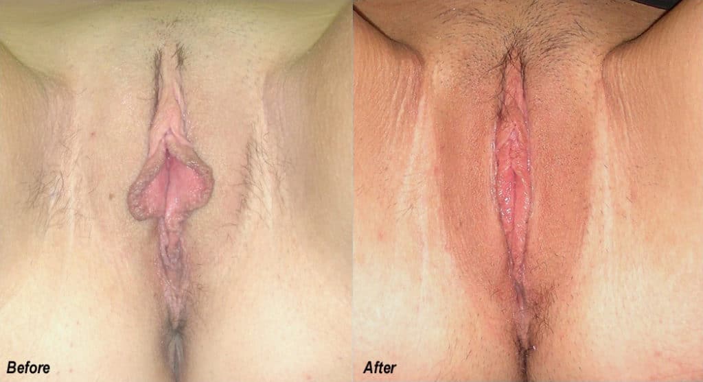 Labiaplasty Before and After Photo by Ganchi Plastic Surgery in Northern New Jersey