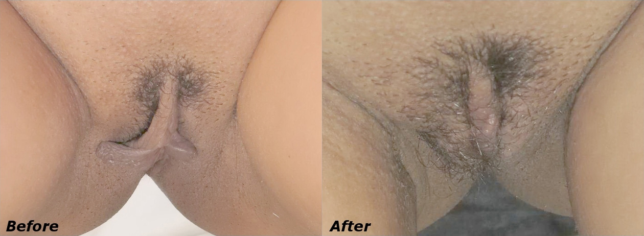 Labiaplasty Before and After Photo by Ganchi Plastic Surgery in Northern New Jersey