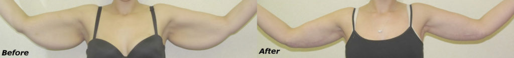 Arm Lift Before and After Photo by Ganchi Plastic Surgery in Northern New Jersey