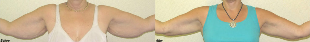 Arm Lift Before and After Photo by Ganchi Plastic Surgery in Northern New Jersey