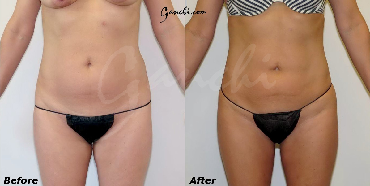 Liposuction Before and After Photo by Ganchi Plastic Surgery in Northern New Jersey