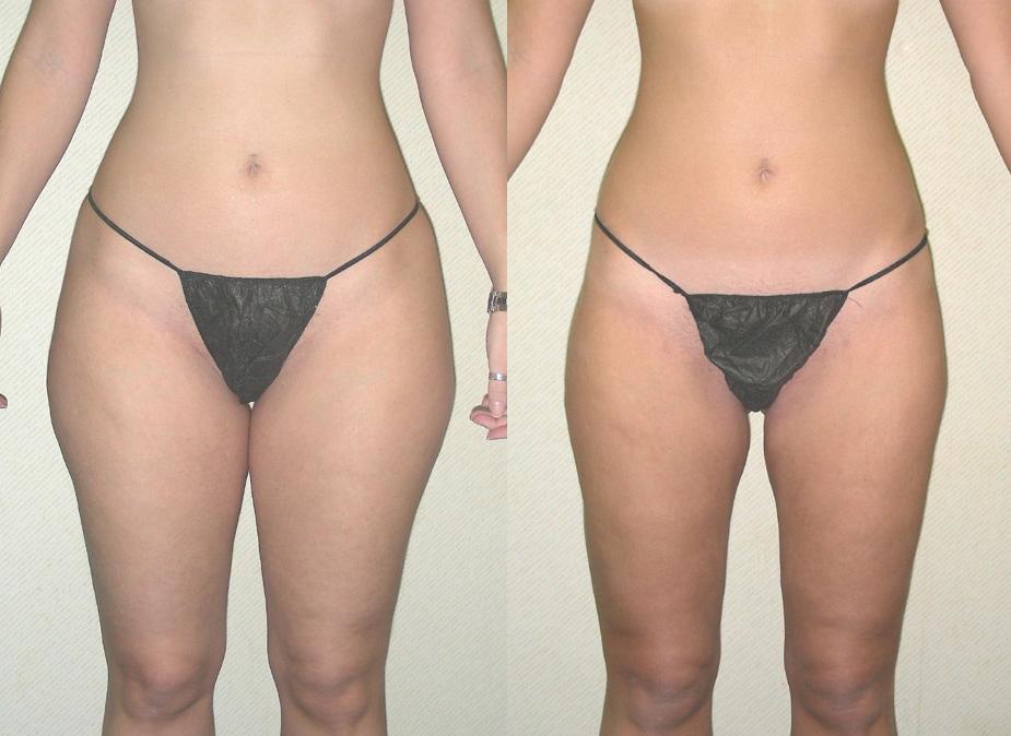 Liposuction Before and After Photo by Ganchi Plastic Surgery in Northern New Jersey