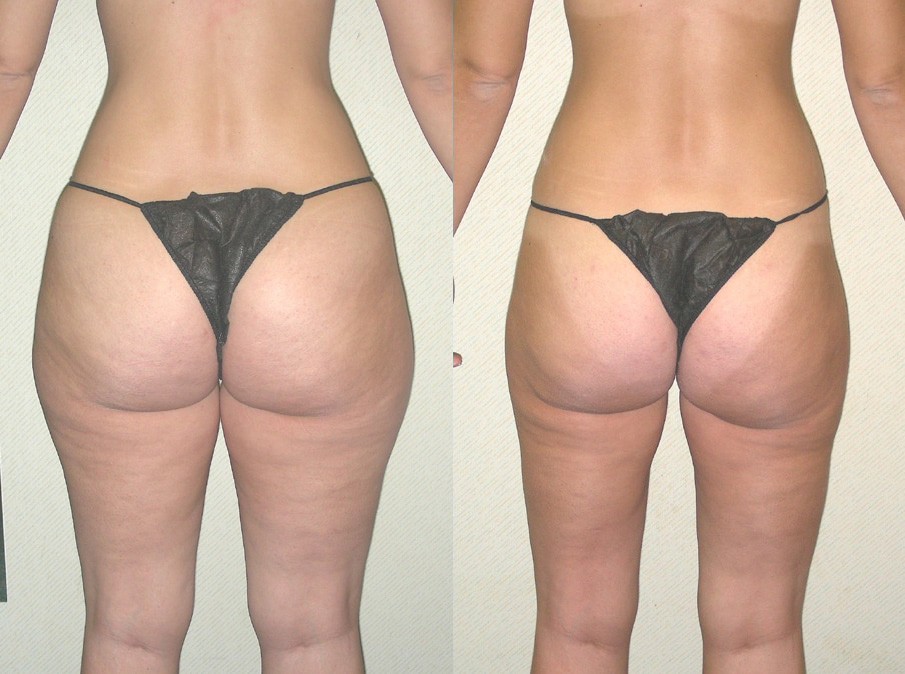 Liposuction Before and After Photo by Ganchi Plastic Surgery in Northern New Jersey